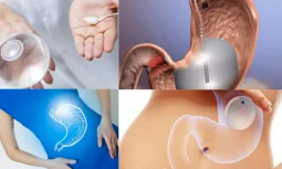 Gastrik Sleeve Ameliyatı Nedir?